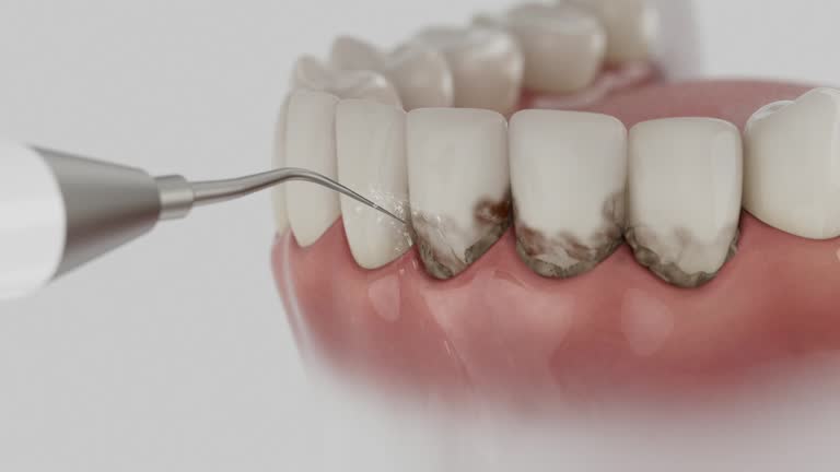 Trusted Wisdom Tooth Removal service in Groesbeck, TX - Dentist Open Now